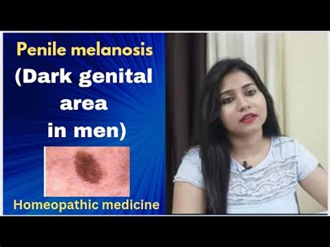 birthmark on penis|Penile Melanosis: Treatment, Removal, and Causes